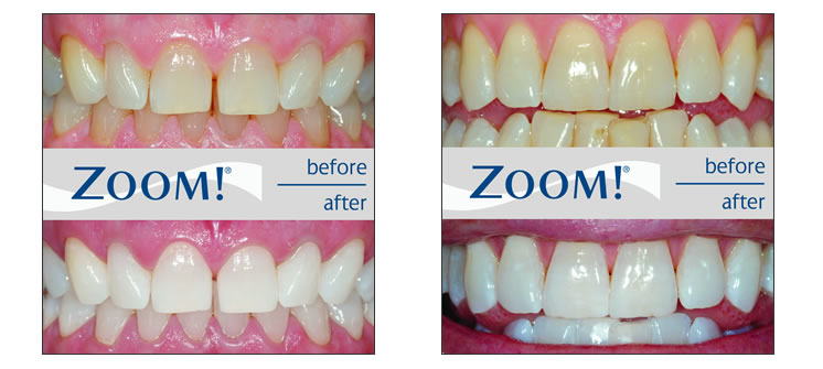 Smile Enhancements  LifeLong Family Dentistry